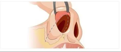 超肋骨鼻1.jpg 超肋骨鼻1.jpg