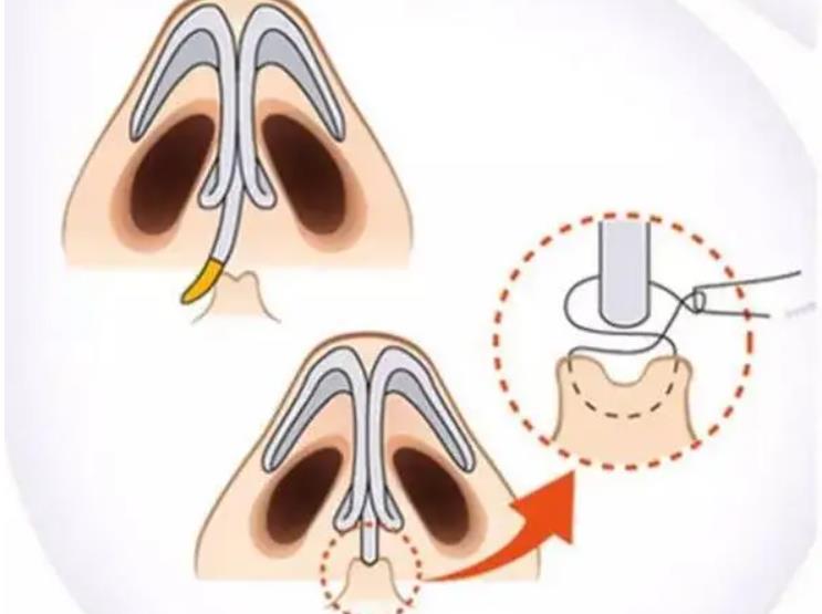 歪鼻3.jpg 歪鼻3.jpg