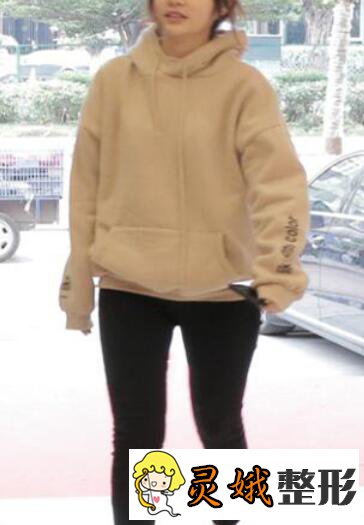 北京禾美嘉李偉民吸脂填充塑形前