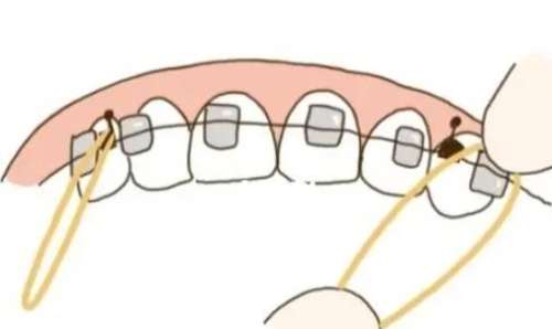 牙齒矯正 牙齒矯正