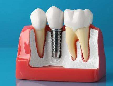 西南醫(yī)院種植牙好還是新橋醫(yī)院種植牙好？分享兩個醫(yī)院簡介一覽