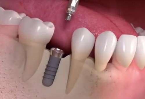 成都華西牙科種植牙多少錢(qián)？種植牙價(jià)格為6000元起