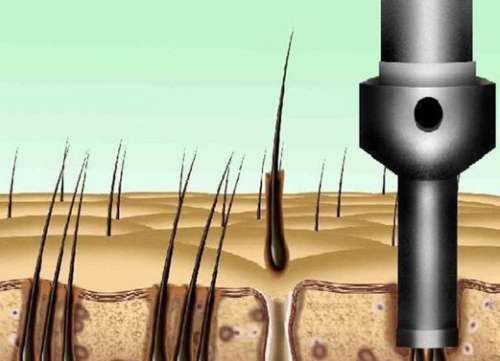 四川省人民醫(yī)院植發(fā)咋樣？熱門醫(yī)院信息預(yù)覽