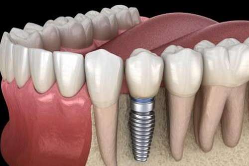 浙大口腔醫(yī)院種植牙怎么樣？含醫(yī)院介紹，醫(yī)生名單了解