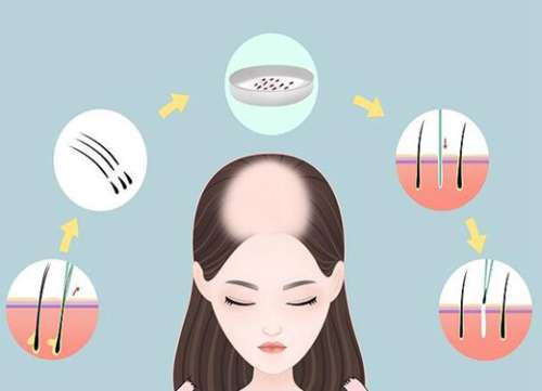 合肥第二人民醫(yī)院植發(fā)費用是多少？匯集價格標(biāo)準(zhǔn)和醫(yī)院評價查看