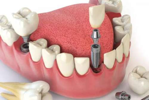 上海六院種植牙價格是多少？匯總價格標準及熱門醫(yī)生分享