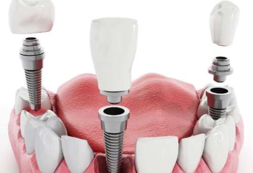 上海六院種植牙怎么樣？了解醫(yī)院信息和醫(yī)生在線推薦