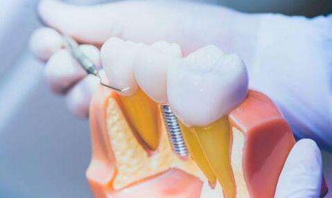 哈爾濱醫(yī)大一種植牙多少錢？分享價格標準-技術(shù)特色了解