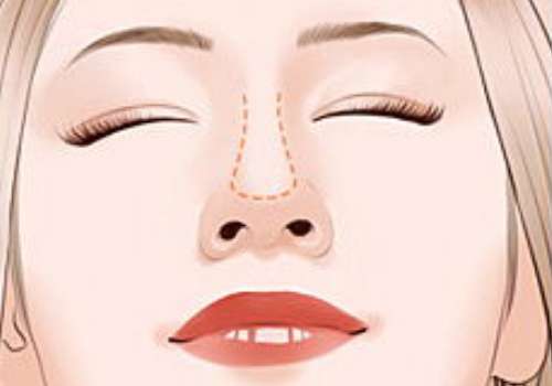 上海新華醫(yī)院隆鼻手術(shù)怎么樣?價(jià)格多少?經(jīng)驗(yàn)案例&技術(shù)測(cè)評(píng)