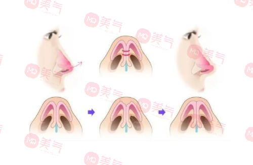 自體肋骨隆鼻的危害有哪些？手術風險、疼痛和腫脹…