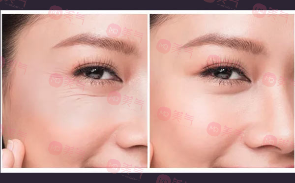 激光去魚(yú)尾紋