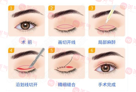 上海九院雙眼皮哪個(gè)醫(yī)生比較好？