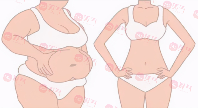 上海九院抽脂哪個(gè)醫(yī)生好？