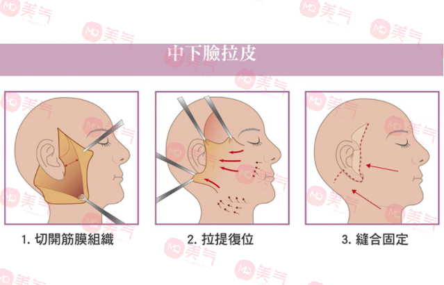 上海九院拉皮手術(shù)哪個(gè)醫(yī)生做的好？