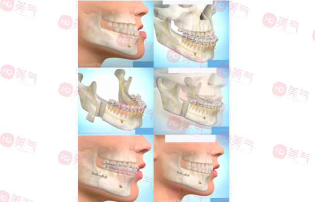 上海九院正頜手術(shù)哪個(gè)醫(yī)生好？