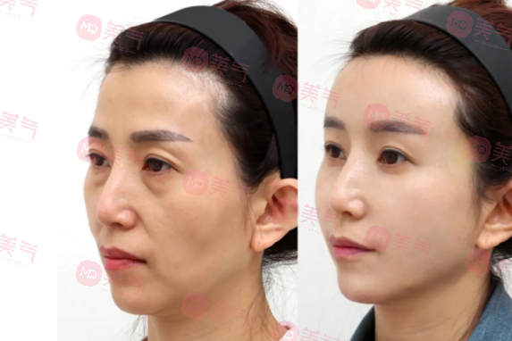 北京八大處整容醫(yī)院做拉皮多少錢？