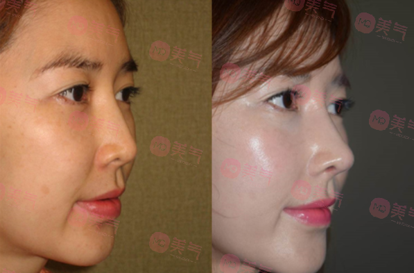 北京八大處做面部脂肪填充多少錢？