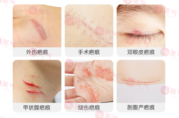 北京八大處整容醫(yī)院做疤痕修復(fù)多少錢？