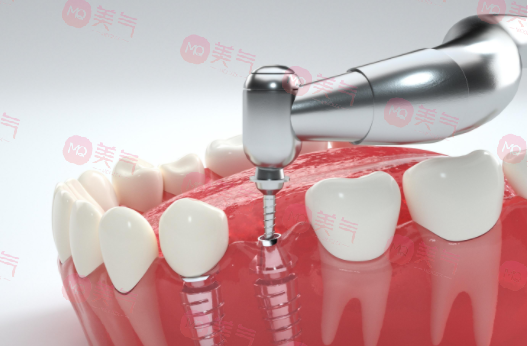 種植牙齒多少錢一顆2023?