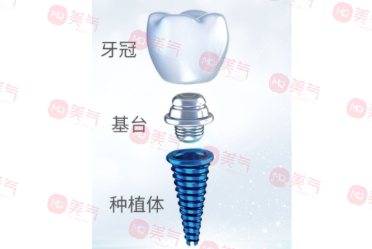 種植牙齒多少錢一顆2023？種植體品牌、醫(yī)生選擇都決定了定價！