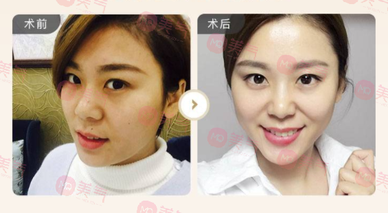 光子嫩膚手術(shù)