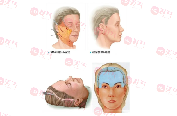 北京煤醫(yī)王馳拉皮手術(shù)多少錢？醫(yī)生技術(shù)介紹+價(jià)格表參考