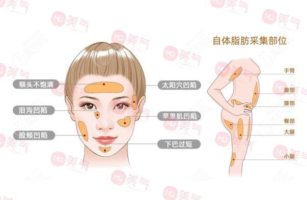 脂肪填充 脂肪填充