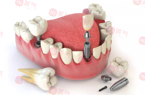 北京種植牙多少錢一顆？價格費用_注意事項_使用年限