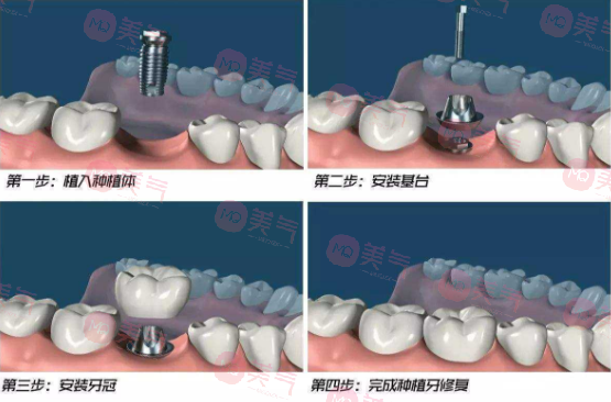 北京種植牙多少錢一顆？價格費(fèi)用_注意事項_使用年限