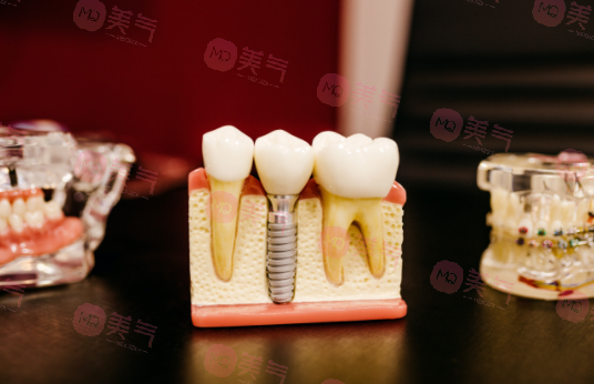 北京種植牙多少錢一顆？價格費(fèi)用_注意事項_使用年限