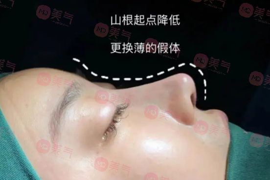 南京醫(yī)科大學友誼做鼻修復的費用多少錢 南京醫(yī)科大學友誼做鼻修復的費用多少錢