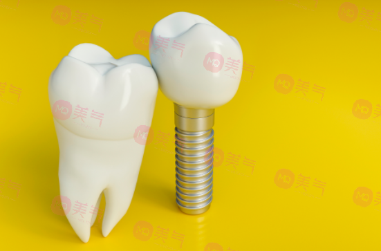 上海種植牙價(jià)格表大全更新！低至5900？?jī)?nèi)附種植牙原理、注意事項(xiàng)