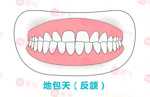 地包天矯正需要多少費(fèi)用？骨性地包天整形費(fèi)用2-4萬起