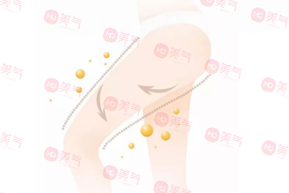 吸脂瘦大腿