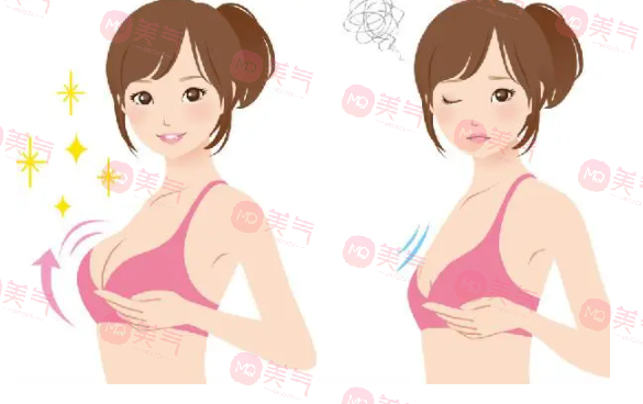 重慶豐胸得多錢？2萬的曼托假體隆胸要不要做