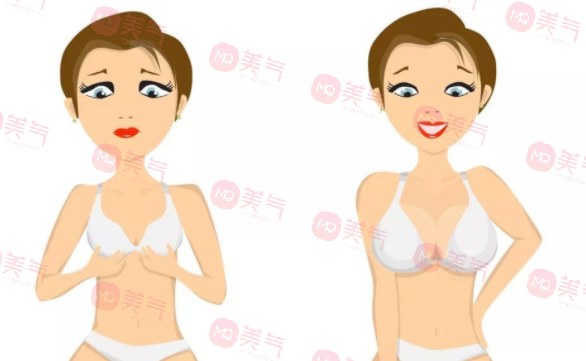 重慶豐胸得多錢？2萬的曼托假體隆胸要不要做