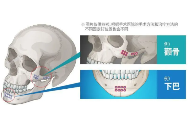 上海李志海和柴崗顴骨顴弓術手術費用分別是多少？