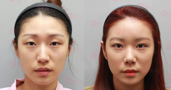 開眼角費(fèi)用大概需要多少錢？