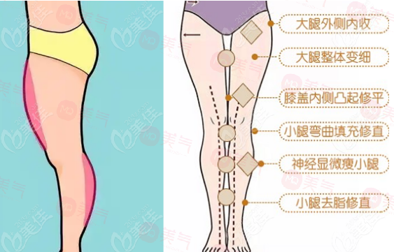 臀部吸脂手術(shù)優(yōu)點(diǎn)、作用、注意事項(xiàng)介紹