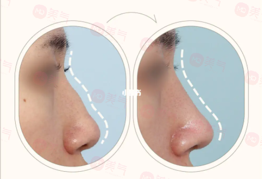 駝峰鼻矯正的手術(shù)方法
