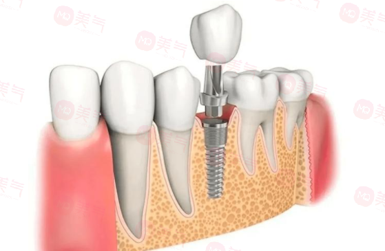 北京種牙多少錢一顆啊2024價格表，北京好的口腔醫(yī)院推薦