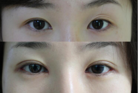 雙眼皮修復(fù)