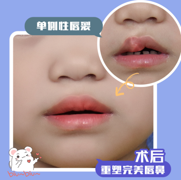 唇裂修復(fù)