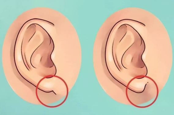耳朵整形