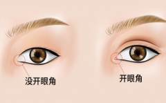 微創(chuàng)開眼角