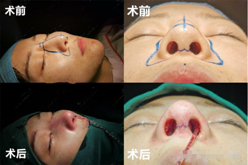 隆鼻失敗修復(fù)