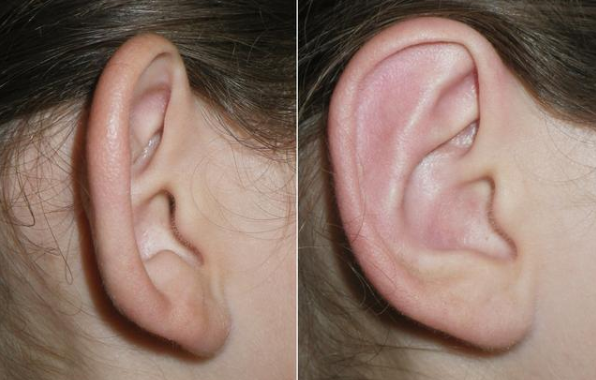 招風(fēng)耳矯正